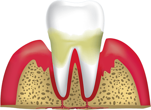 gum disease stage 3