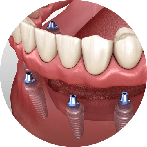All on dental implants 3