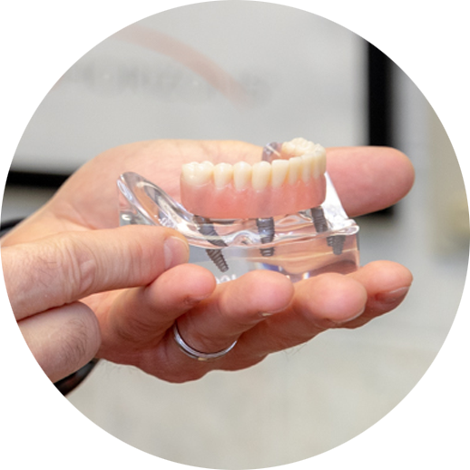 full mouth dental implant model