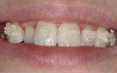crooked teeth before treatment
