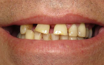 dental implant patient before treatment