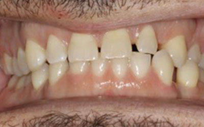 Misaligned teeth 3