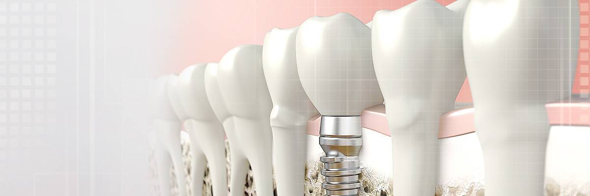 Picture of Dental Implant procedure