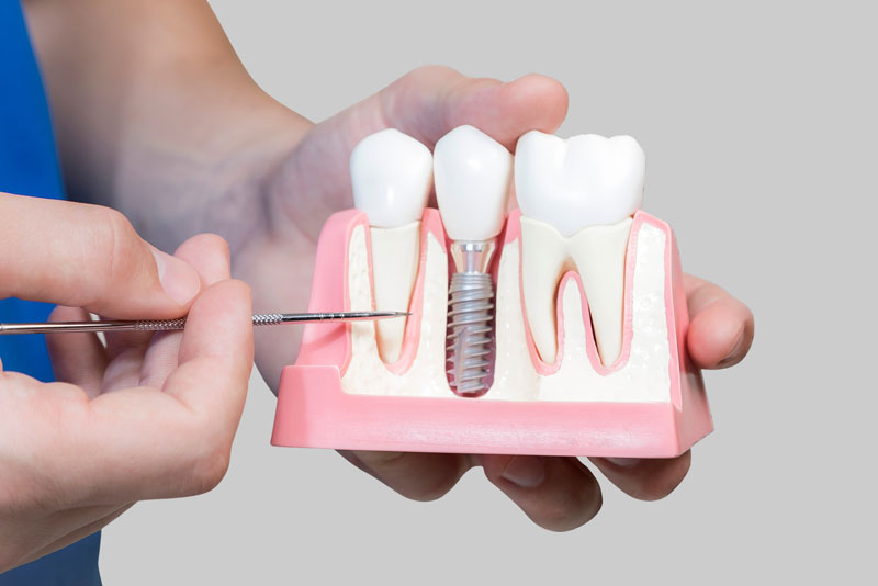 Dental Assistant Showing Off A Dental Implant In A Jawbone Cutaway Model in Bloomington, MN