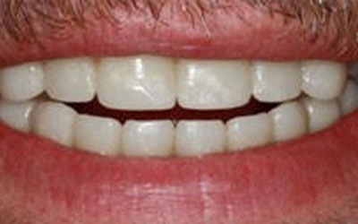 Teeth whitening 5