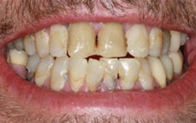 Person suffering from gum disease 4
