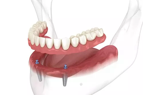 Denture Stabilization 3