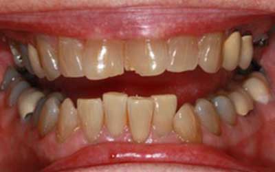 Person suffering from gum disease