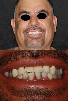 Misaligned teeth 3