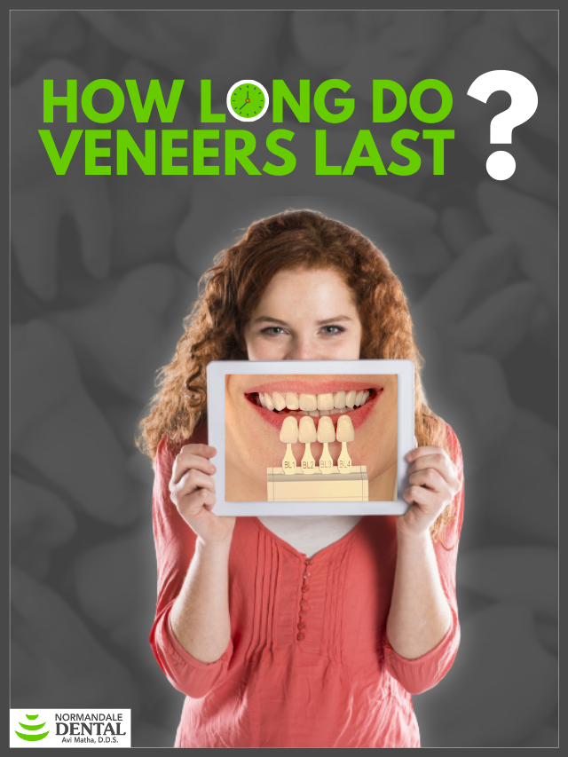 Veneers Guide For a Gorgeous Smile