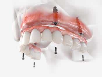What do you mean by All-on-4 Dental Implants