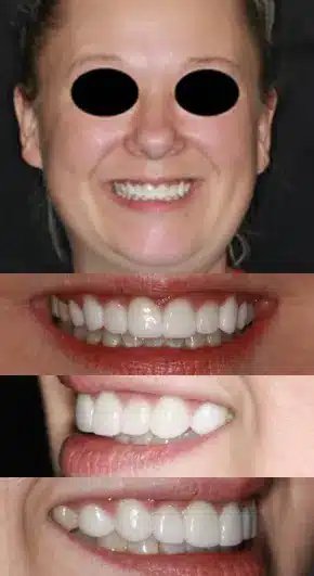 Teeth whitening procedure done for a beautiful woman