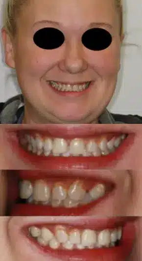Misaligned teeth being treated at Normandale Dental