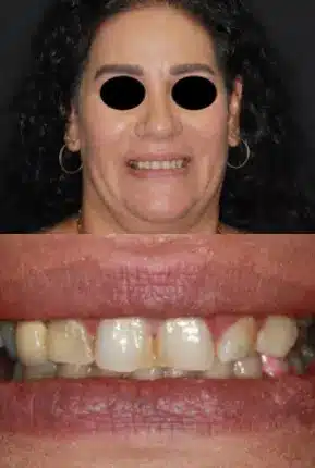 Woman suffering from misaligned teeth