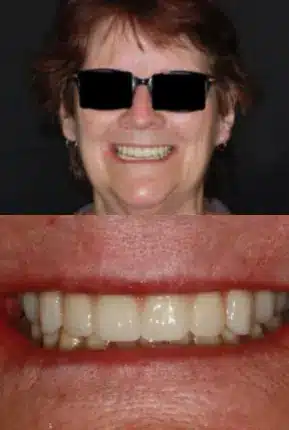 Implant supported dentures