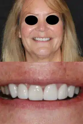 Teeth whitening procedure done at Normandale Dental
