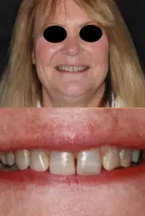 Woman suffering from gum disease