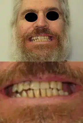 An old man having misaligned teeth