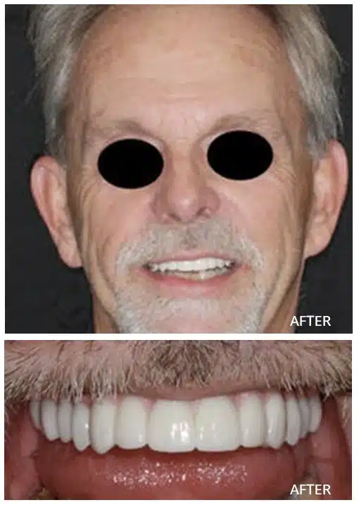 Implant supported dentures done for the old man