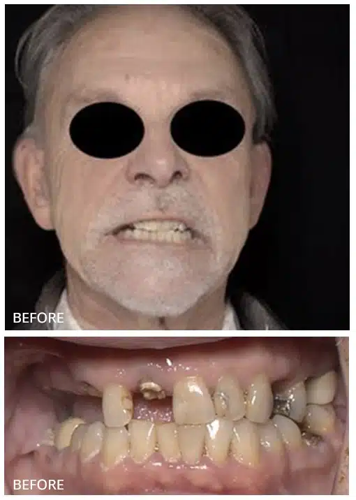 Implant supported dentures done for the old man 2
