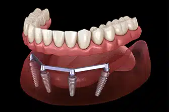 What Is All-On-4 Dental Implants? ​