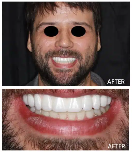After teeth whitening treatment image -2