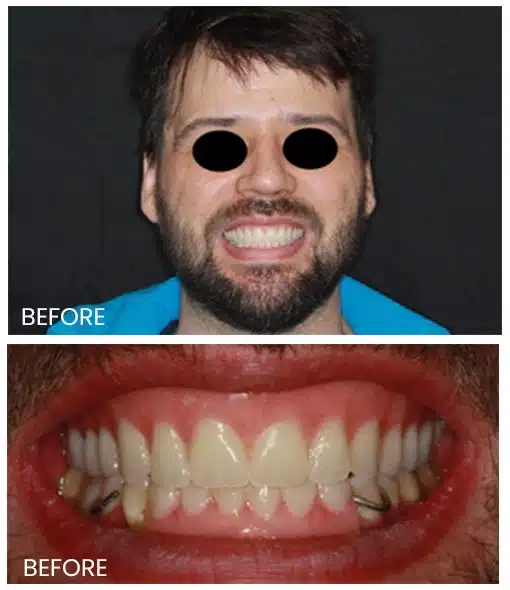 patient's teeth alignment image