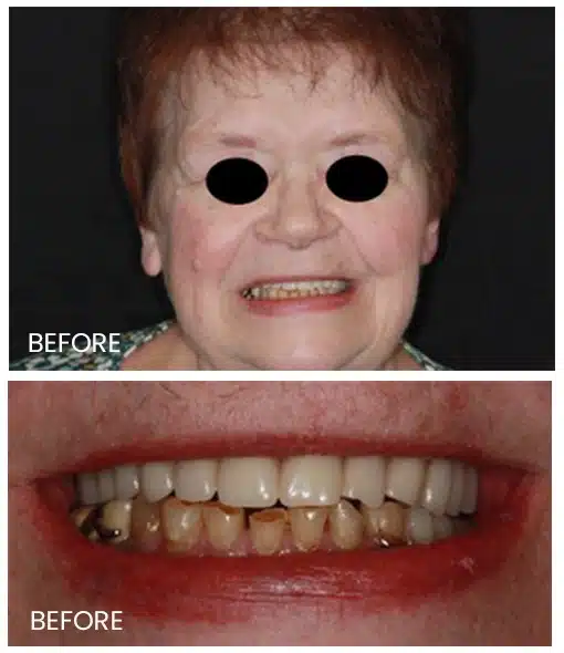 patients allergic teeth 2