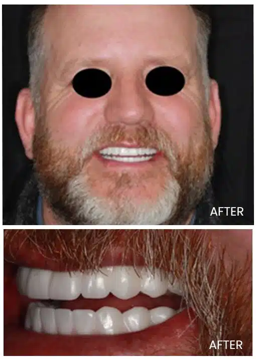 After teeth alignment treatment