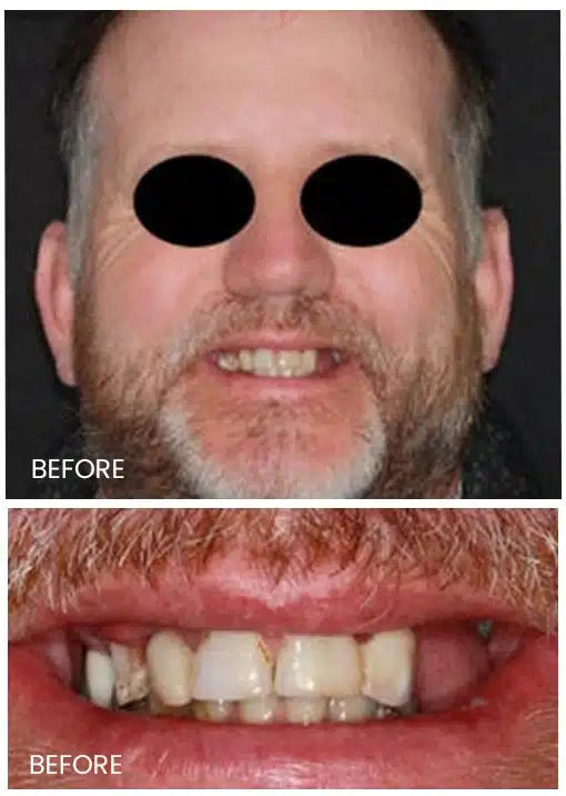 uneven teeth of a patient-2