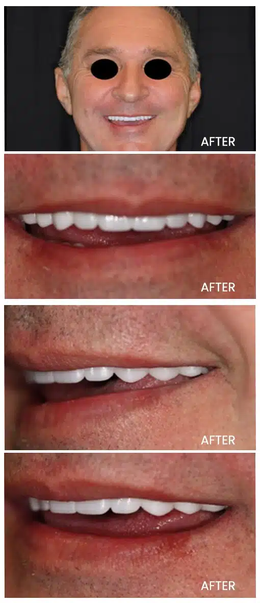 after smile makeover treatment image