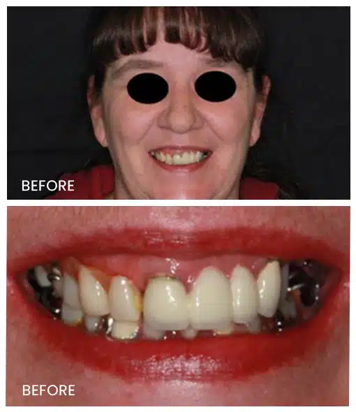 patients allergic teeth