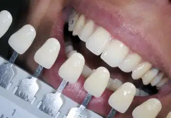 Checking the right match of Dental Veneers