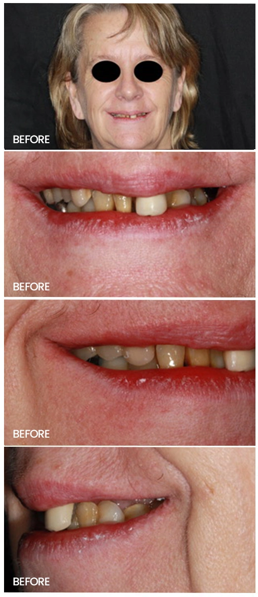 before and after teeth treatment image