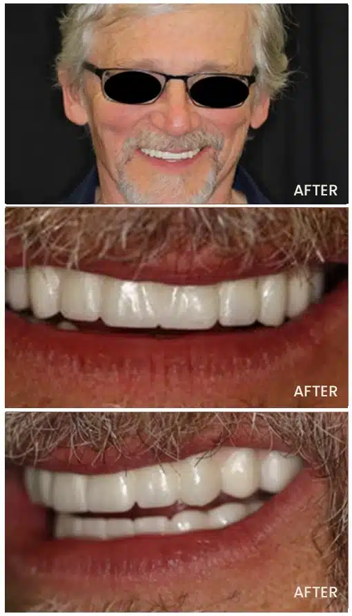 teeth whitening treatment images