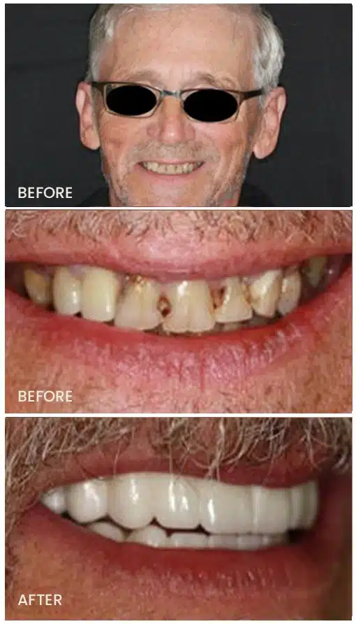 before after teeth whitening